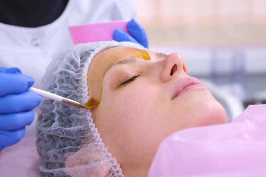 Chemical peel being applied