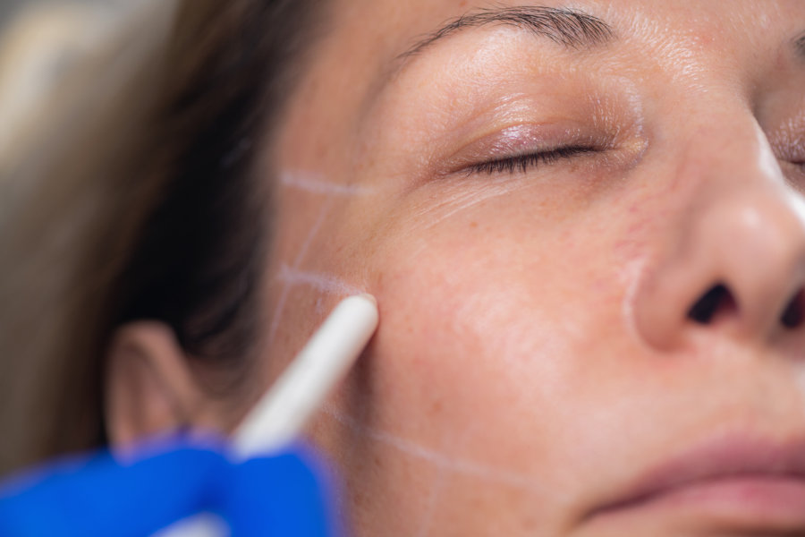 Woman being prepared for the instalift treatment