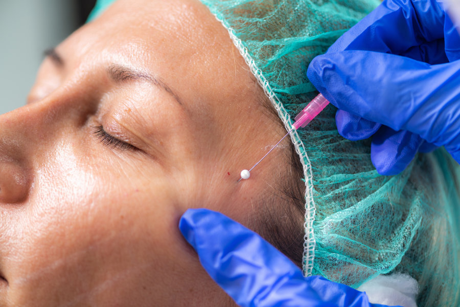 A woman receiving an Instalift face lift