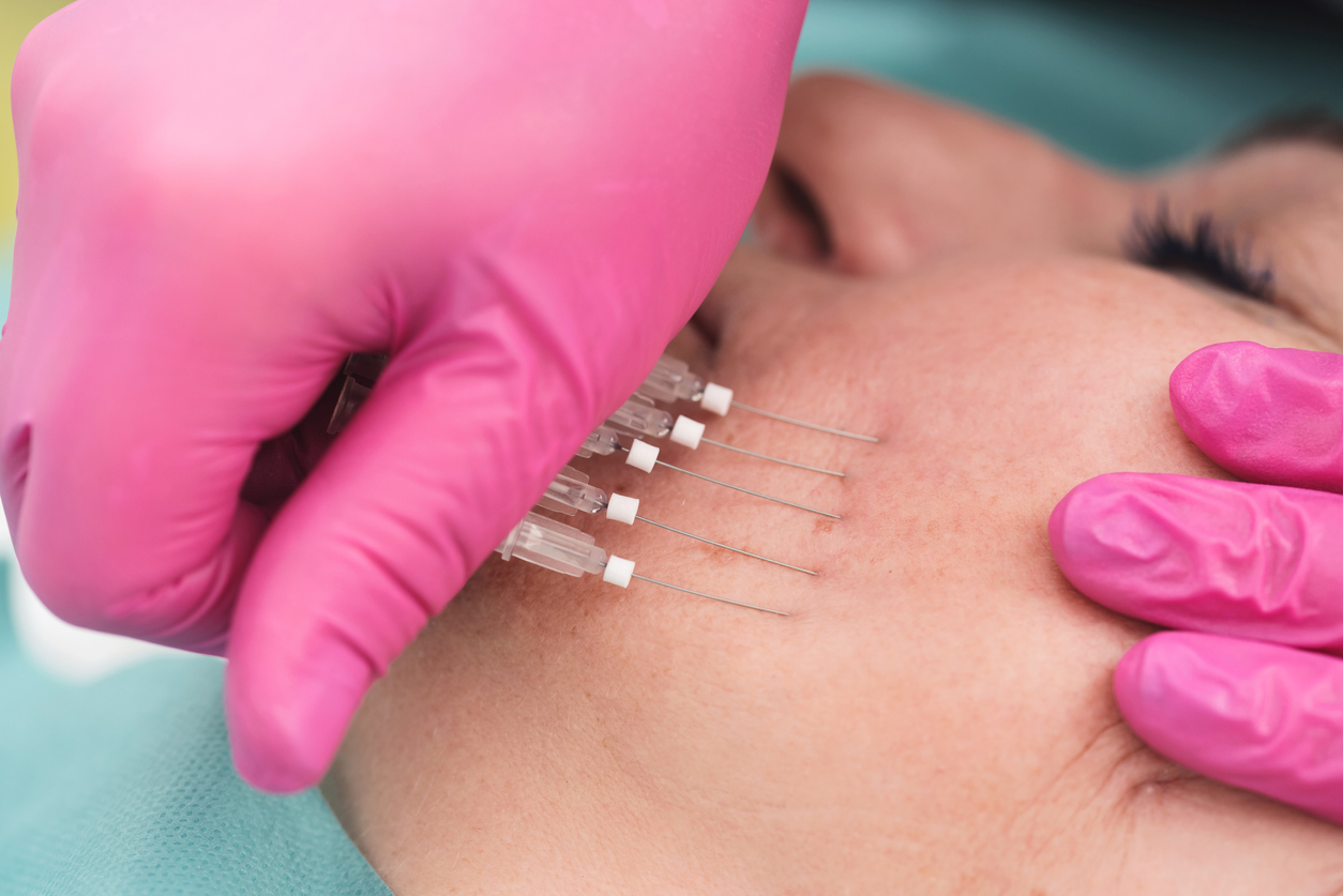 Thread needles being applied