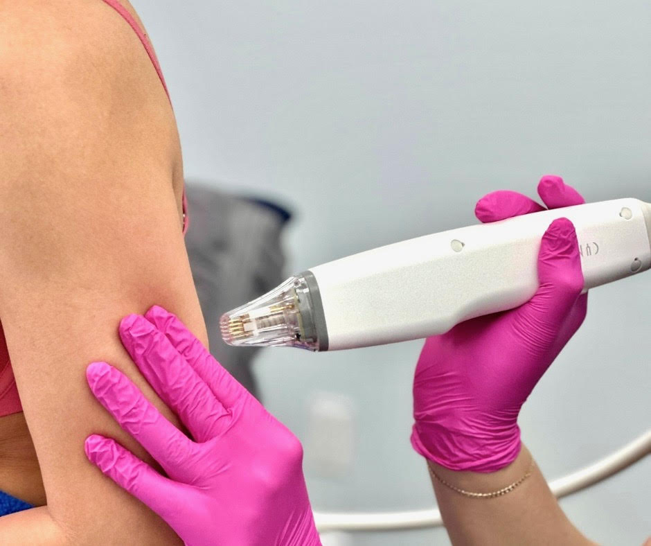 rf microneedling